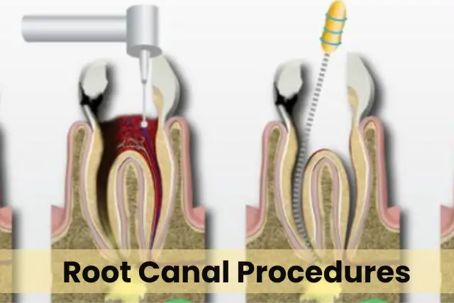 Root Canal Procedures